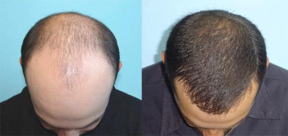 Hair Transplant and Treatment Services