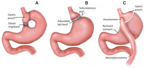 Weight-Loss Surgery